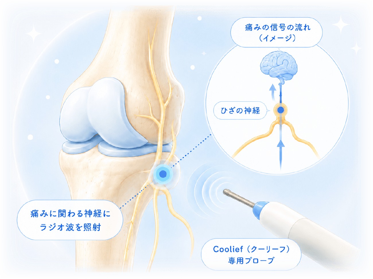 慢性的なひざの痛みに、神経からアプローチする治療